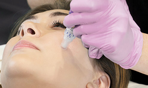 Microneedling Englewood
