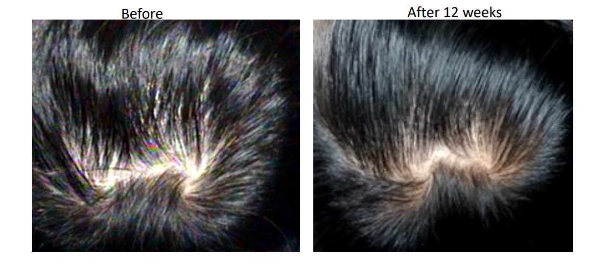 laser hair loss treatment englewood, nj
