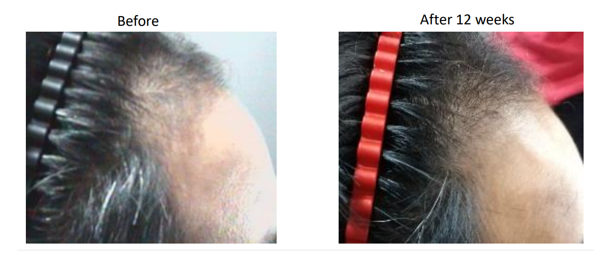 laser hair loss treatment englewood, nj