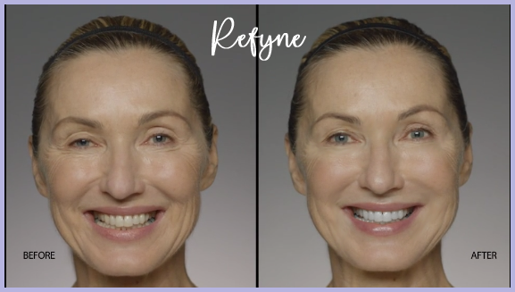 Restylane Before & After