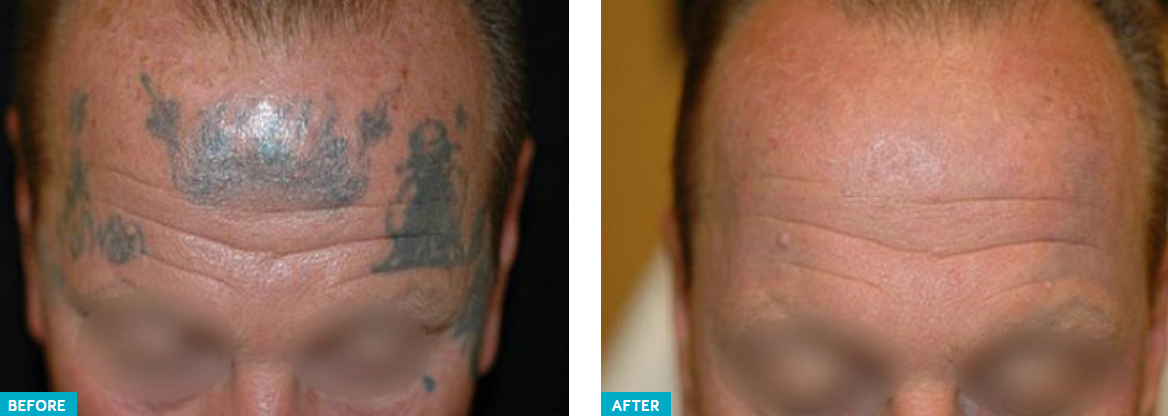 Laser Tattoo Removal  Scotch Plains NJ Ohana Medical Spa
