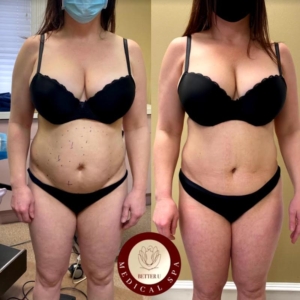 bodytite fatloss treatment bergen county