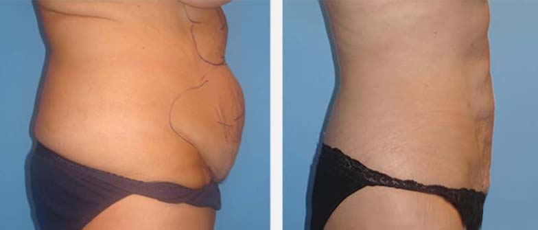  bodytite lipo before & after
