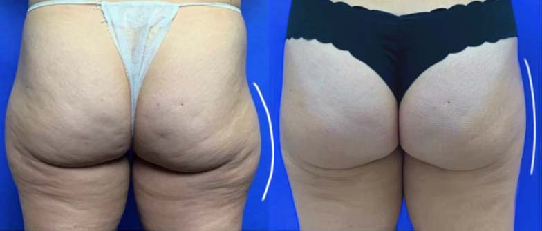  bodytite lipo before & after