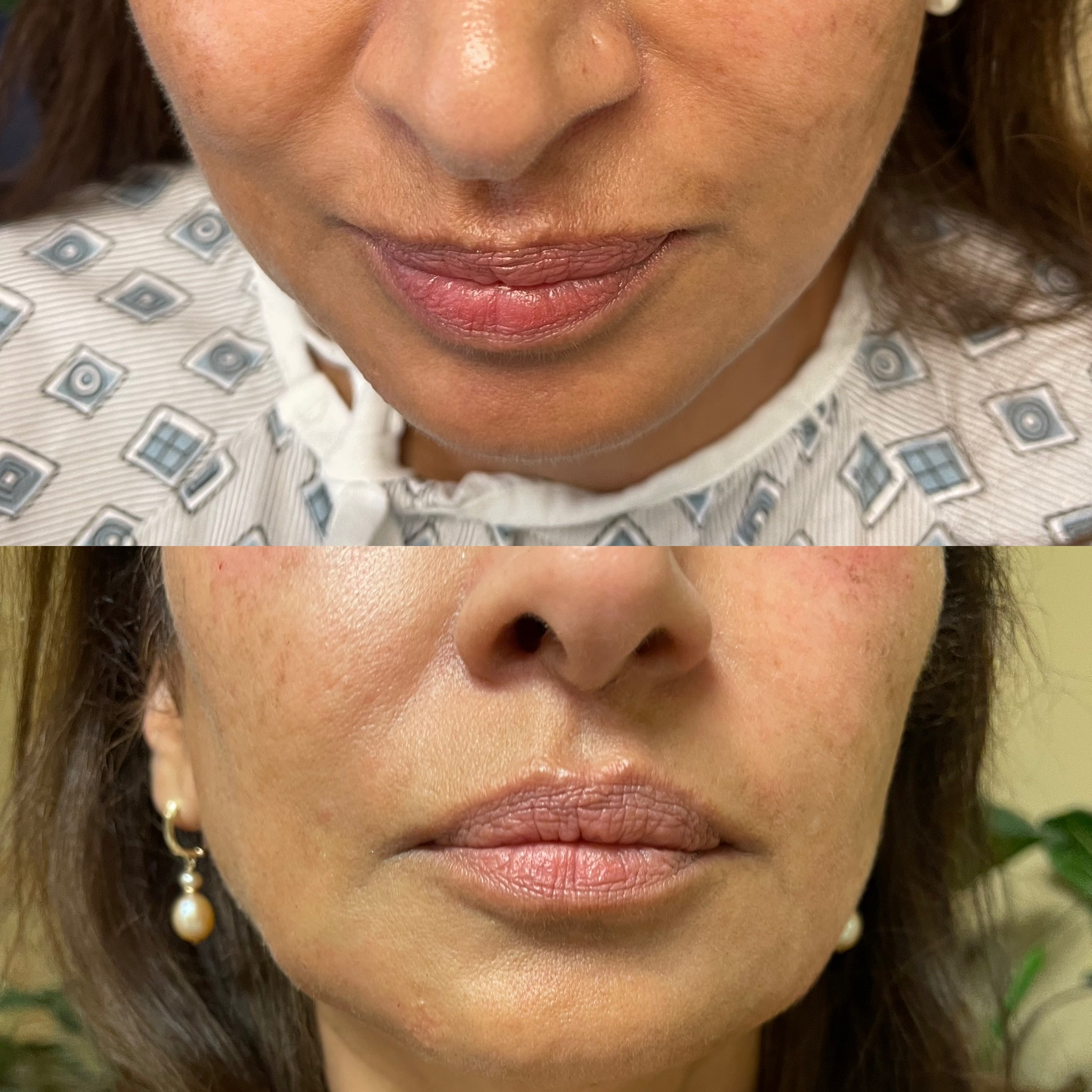 Chin Filler Before & After