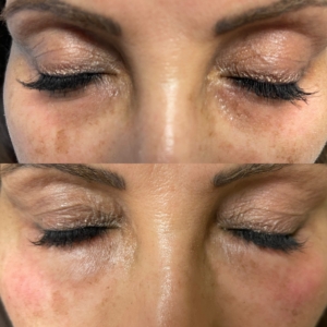 Tear Trough Filler Before & After