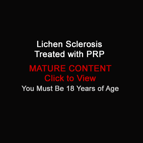 lichen sclerosis prp treatment